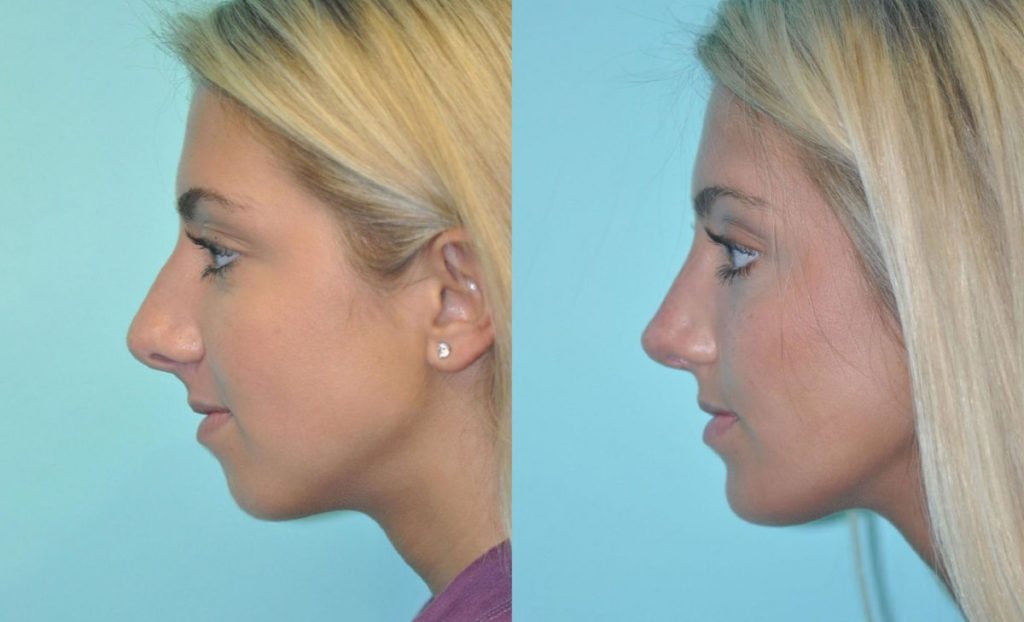 Chin Augmentation Surgery, What You Should Know